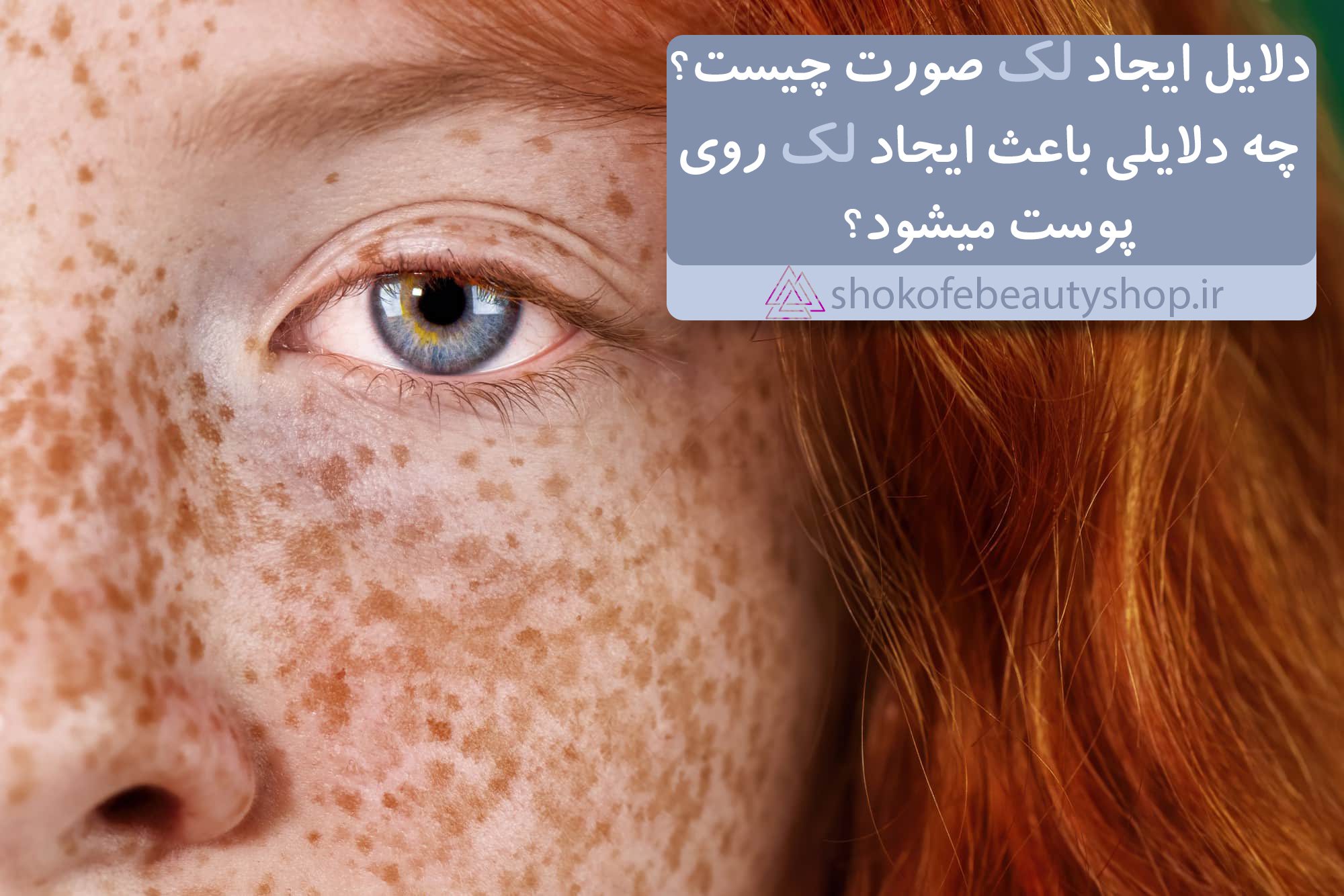 چه دلایلی باعث ایجاد لک های پوست میشود؟|دلایل ایجاد لک صورت چیست